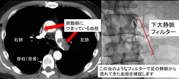 40代男性 動悸がする。 不整脈かと思ったが・・・・